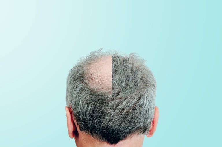 The 25 Best Celebrity Hair Transplants (Before and After) 8 The 25 Best Celebrity Hair Transplants (Before and After)