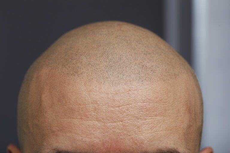Are Hair Transplants Permanent? Your New Hair Over Time 7 Are Hair Transplants Permanent? Your New Hair Over Time