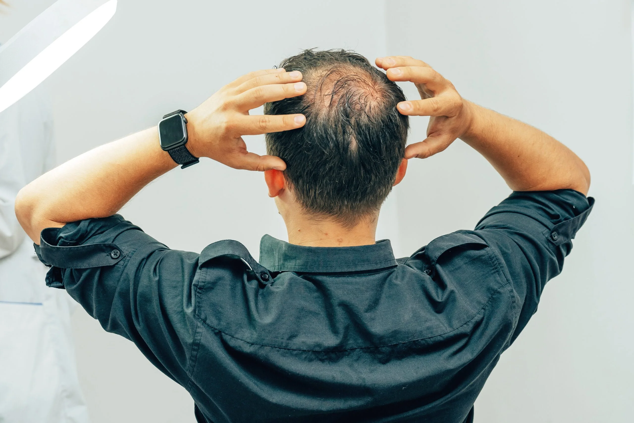 balding crown scaled