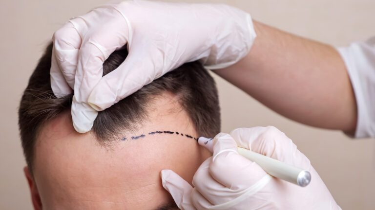 How to Choose the Right Hairline for Your Hair Transplant: Low vs. Natural 5 How to Choose the Right Hairline for Your Hair Transplant: Low vs. Natural