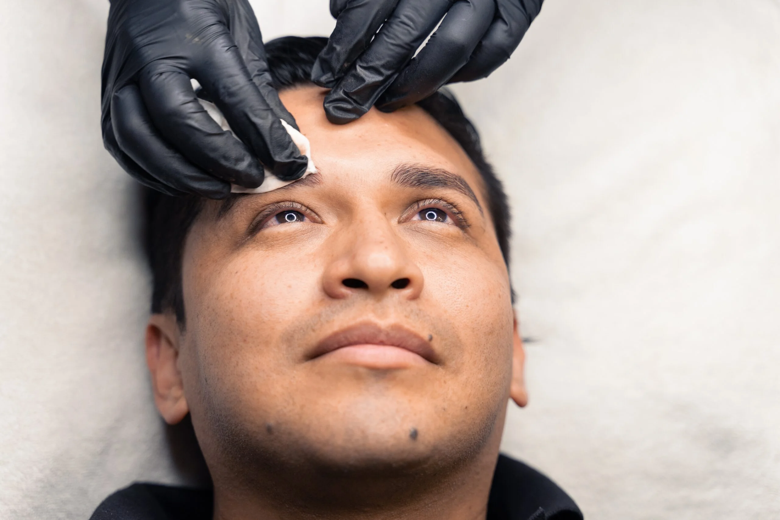 greffes de sourcils écaillées