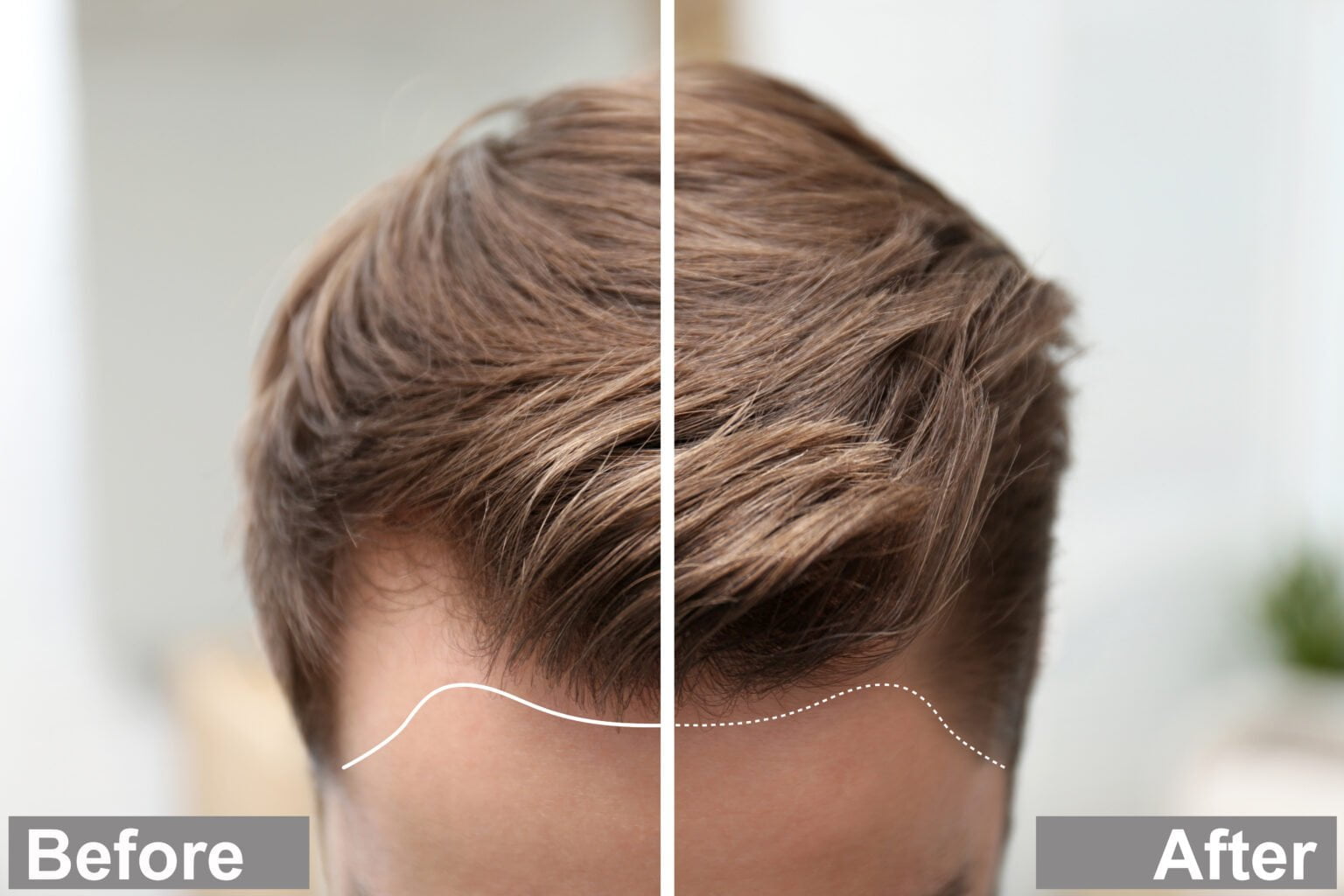 How Long After A Hair Transplant Are New Hair Grafts Secure How Long After A Hair Transplant Are New Hair Grafts Secure