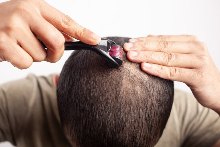 How Long to See Results from Derma Roller for Hair? 4 time to see results from derma rolling/microneedling