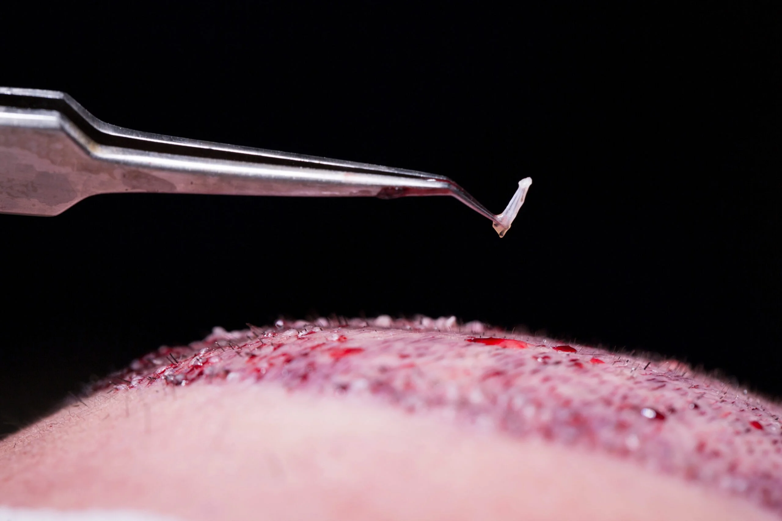 how many grafts do you need hair transplant scaled