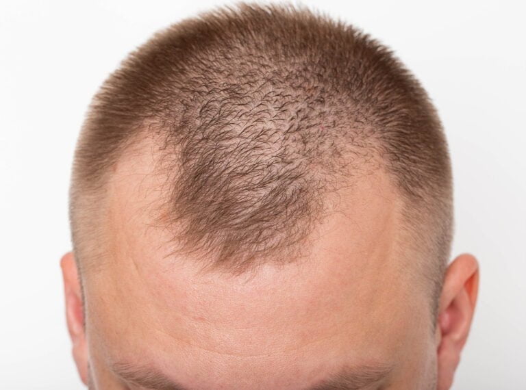 How to Restore Receding Temples With a Hair Transplant 5 How to Restore Receding Temples With a Hair Transplant