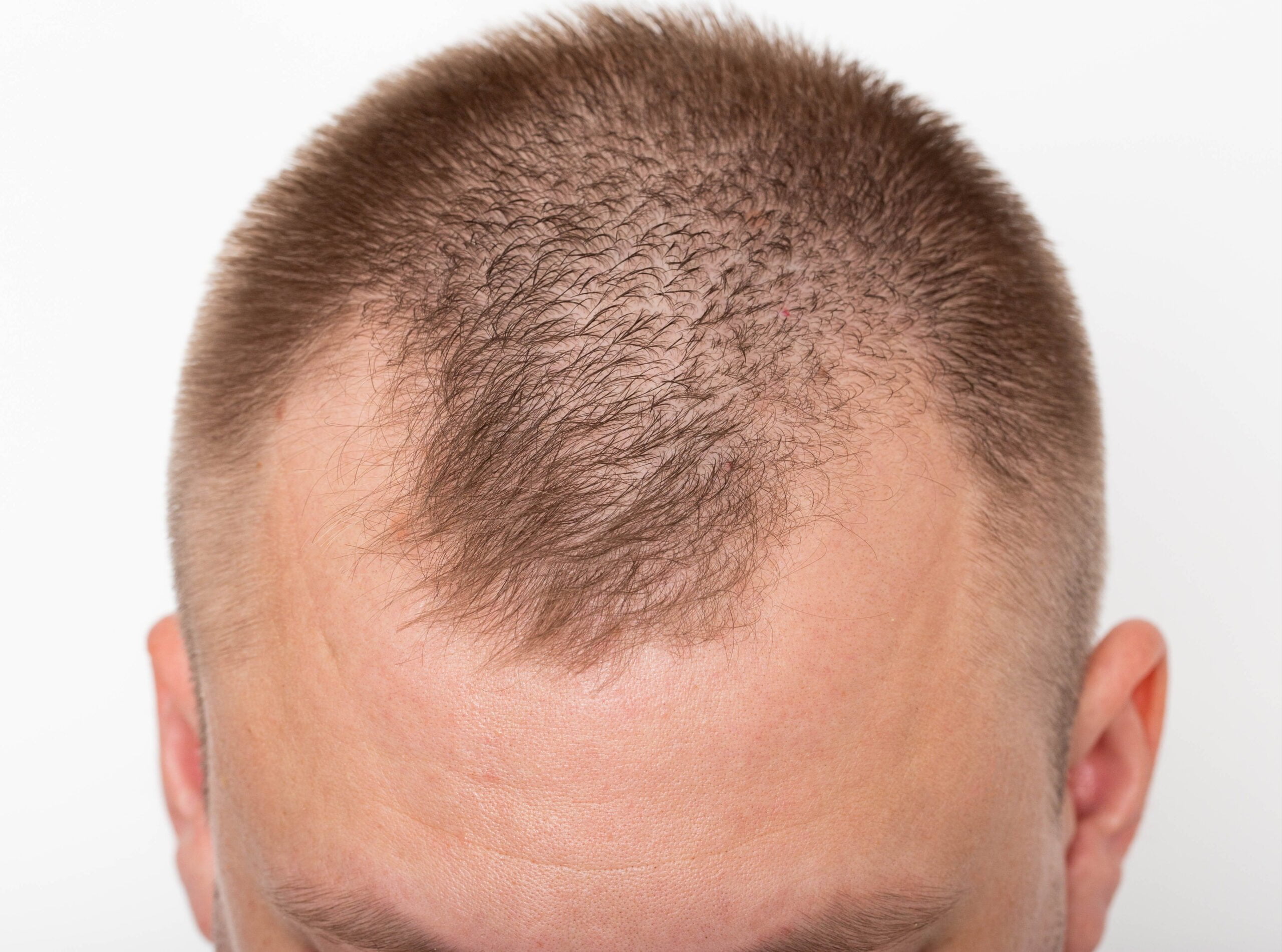 Wie man zurückweichende Schläfen mit einer Haartransplantation wiederherstellt 1 wie man zurückweichende Schläfen mit einer Haartransplantation wiederherstellen kann