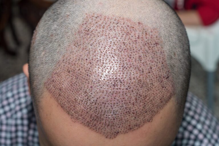 Redness After a Hair Transplant: What You Need to Know 5 Redness After a Hair Transplant: What You Need to Know