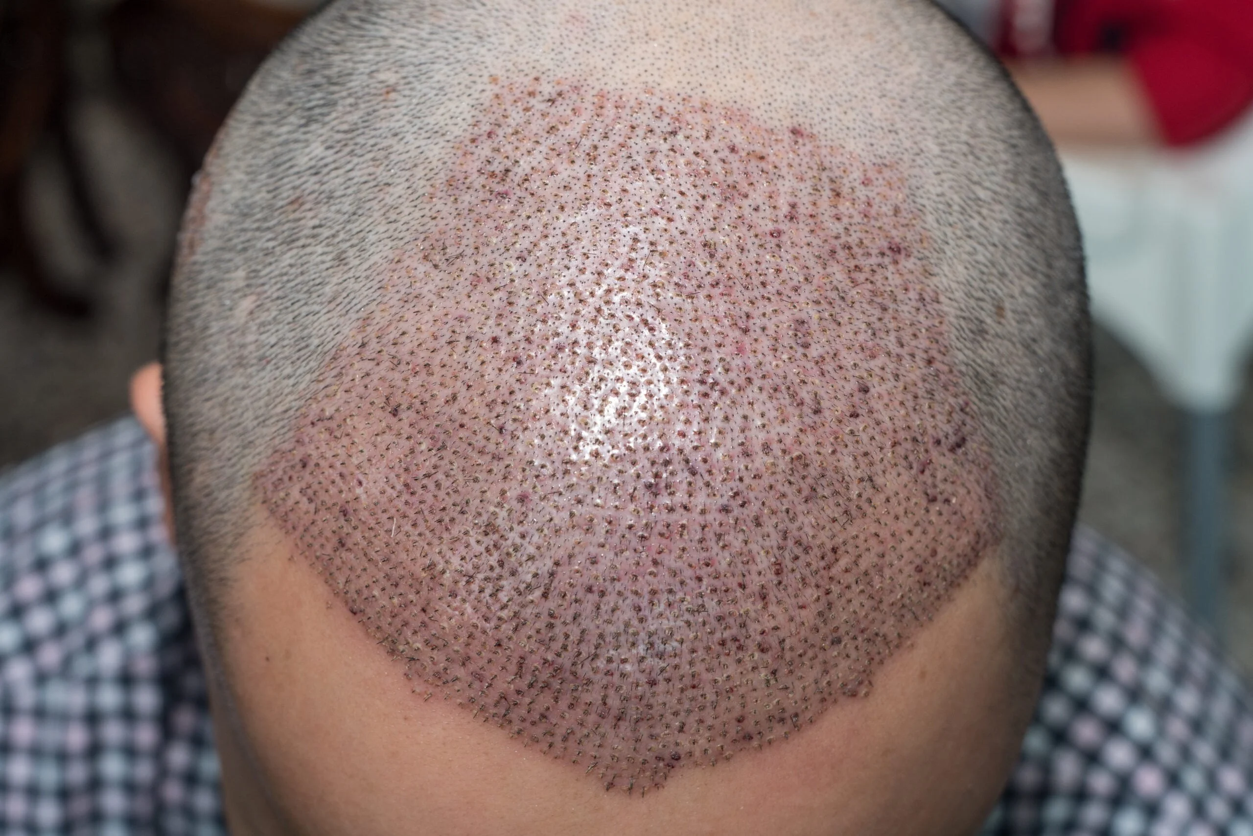 redness after a hair transplant scaled