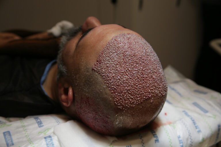 Swelling After a Hair Transplant: What to Expect & How to Reduce 8 Swelling After a Hair Transplant: What to Expect & How to Reduce