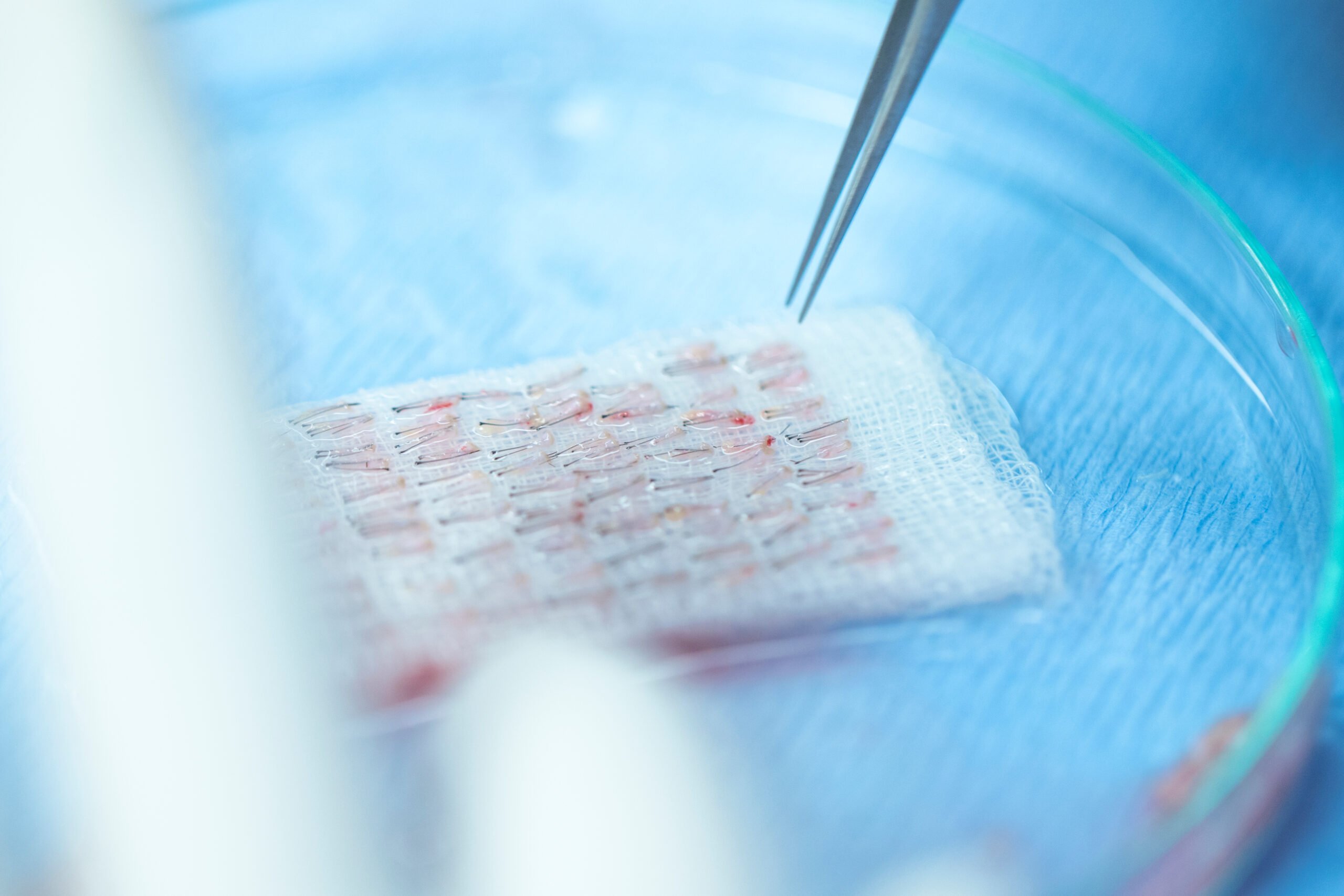 Что такое графты волос (как они выглядят и как их берут) 1 что такое пересадка волос