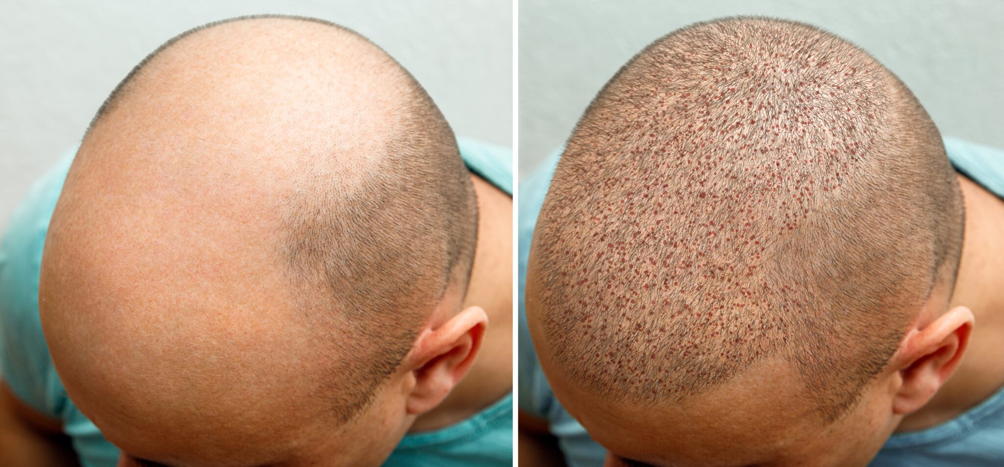 What Hair Transplant Growth Results Look Like Over 12 Months 