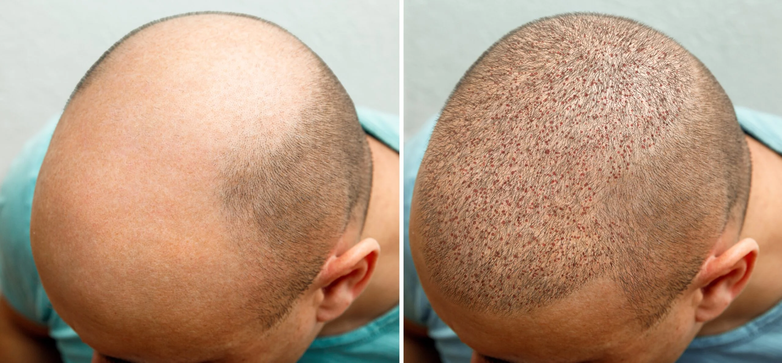 what hair transplant growth results look like over 12 months scaled