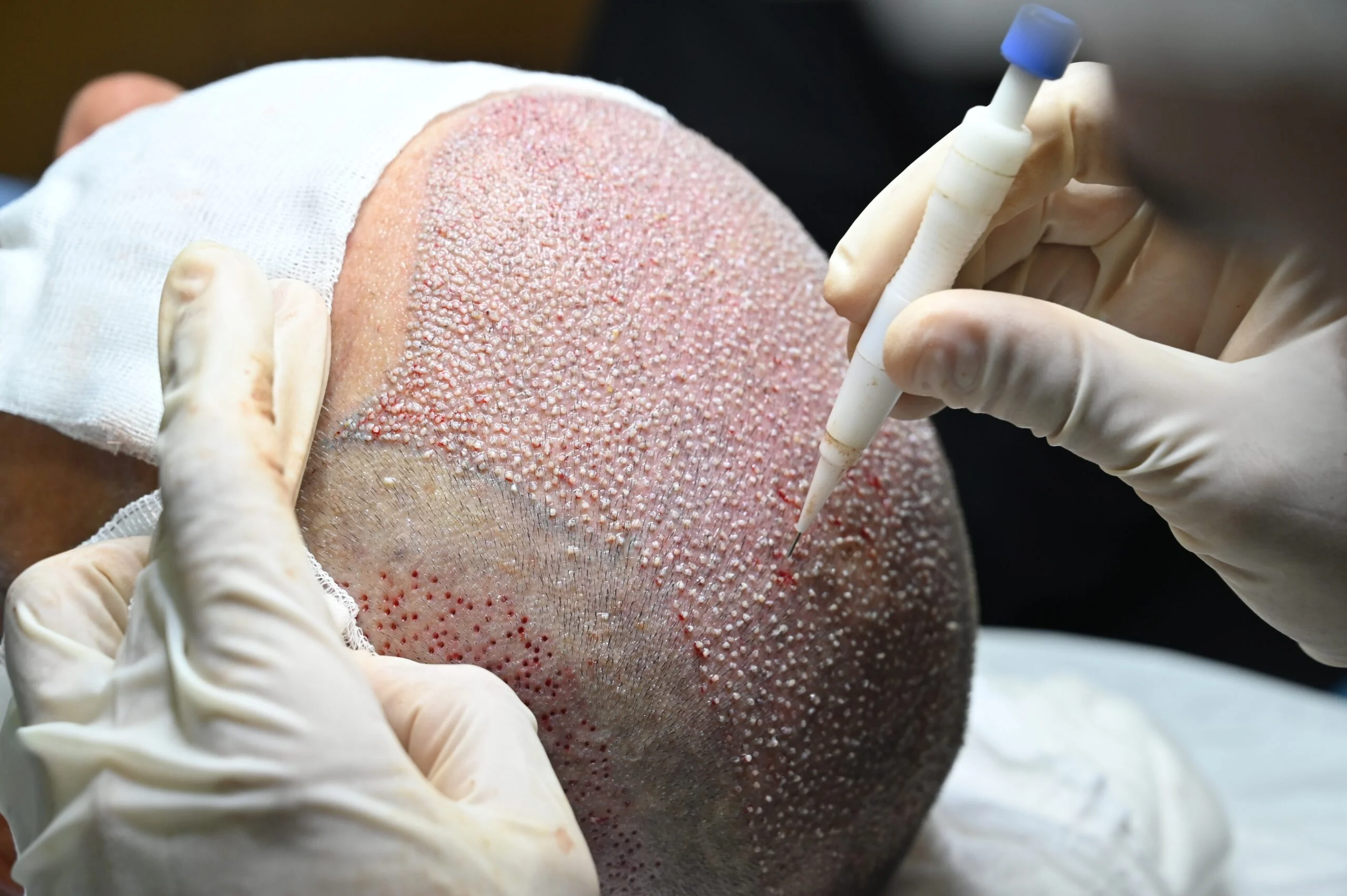 o que é um transplante de cabelo dhi escalado