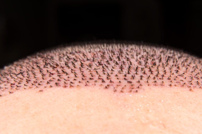 Hair Transplants & Scars: What You Need to Know 4 Hair Transplants & Scars: What You Need to Know