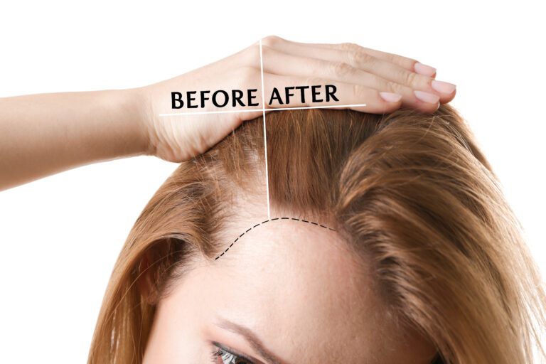 Hair Transplants for Women: All You Need to Know (Costs and More) 5 Hair Transplants for Women: All You Need to Know (Costs and More)