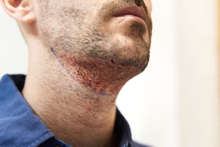 The Definitive Guide to Beard Transplants (Costs & More) 4 beard transplant