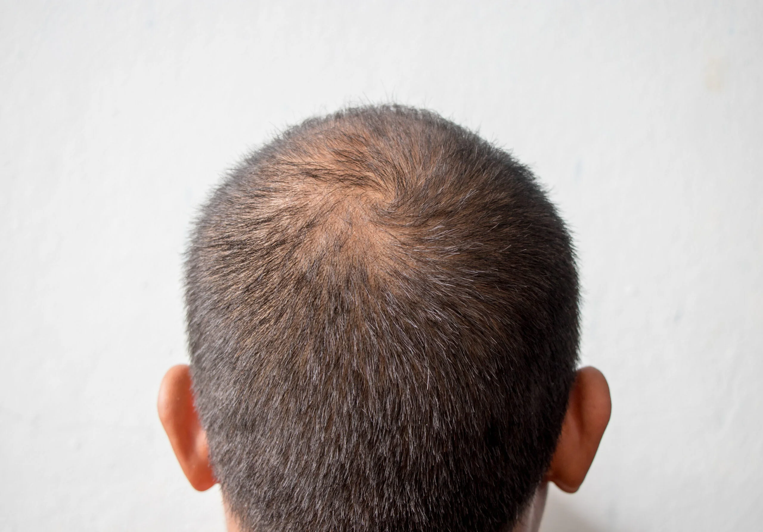 hasil dari finasteride