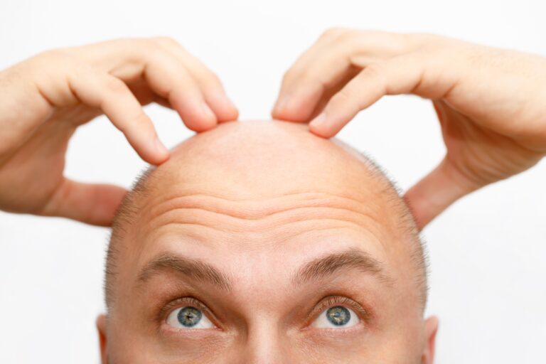 Hair Plugs vs. Hair Transplants: Are They the Same Thing? 4 hair transplant vs hair plugs
