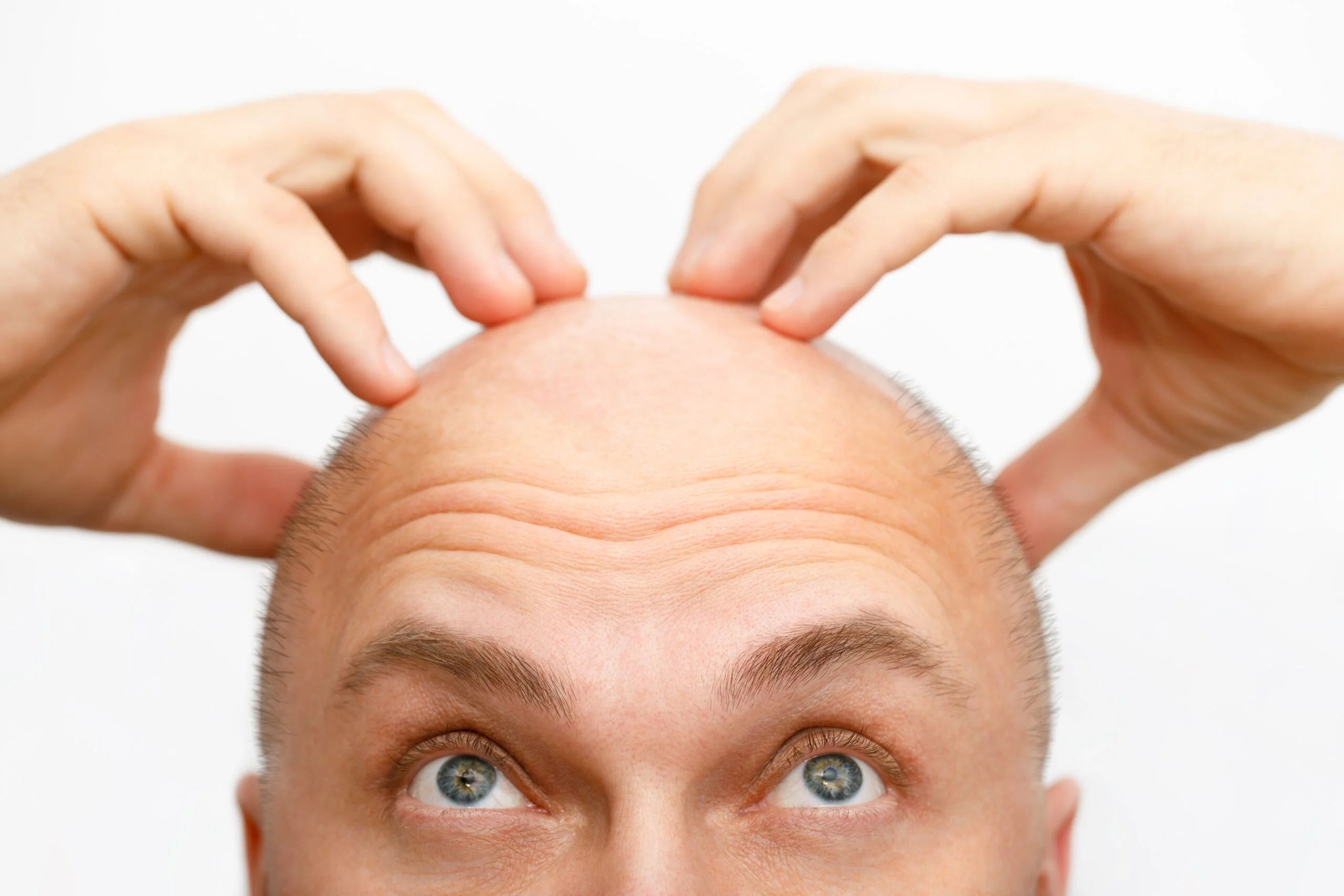 Haartransplantation vs. Haarplugs