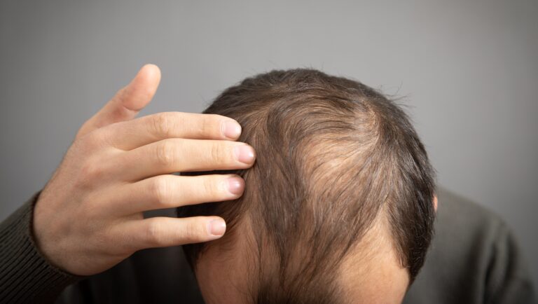 Hair Transplants: Everything You Need to Know Before Getting One 6 Hairs transplants