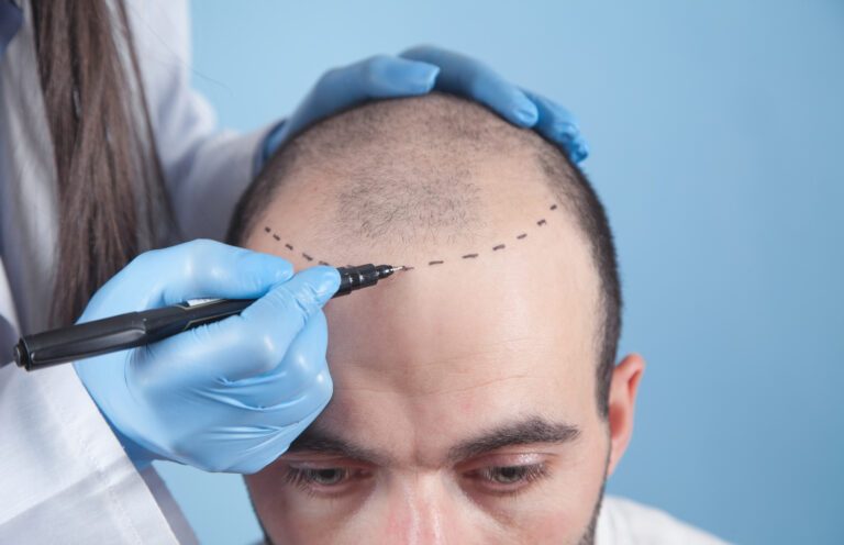 Can You Restore Your Widow’s Peak With a Hair Transplant? 7 fixing a widows peak with a hair transplant