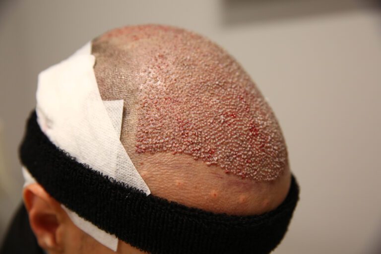 Hair Transplant Scabs & Crusting: Everything You Need to Know 7 scabs and crusting when getting a hair transplant