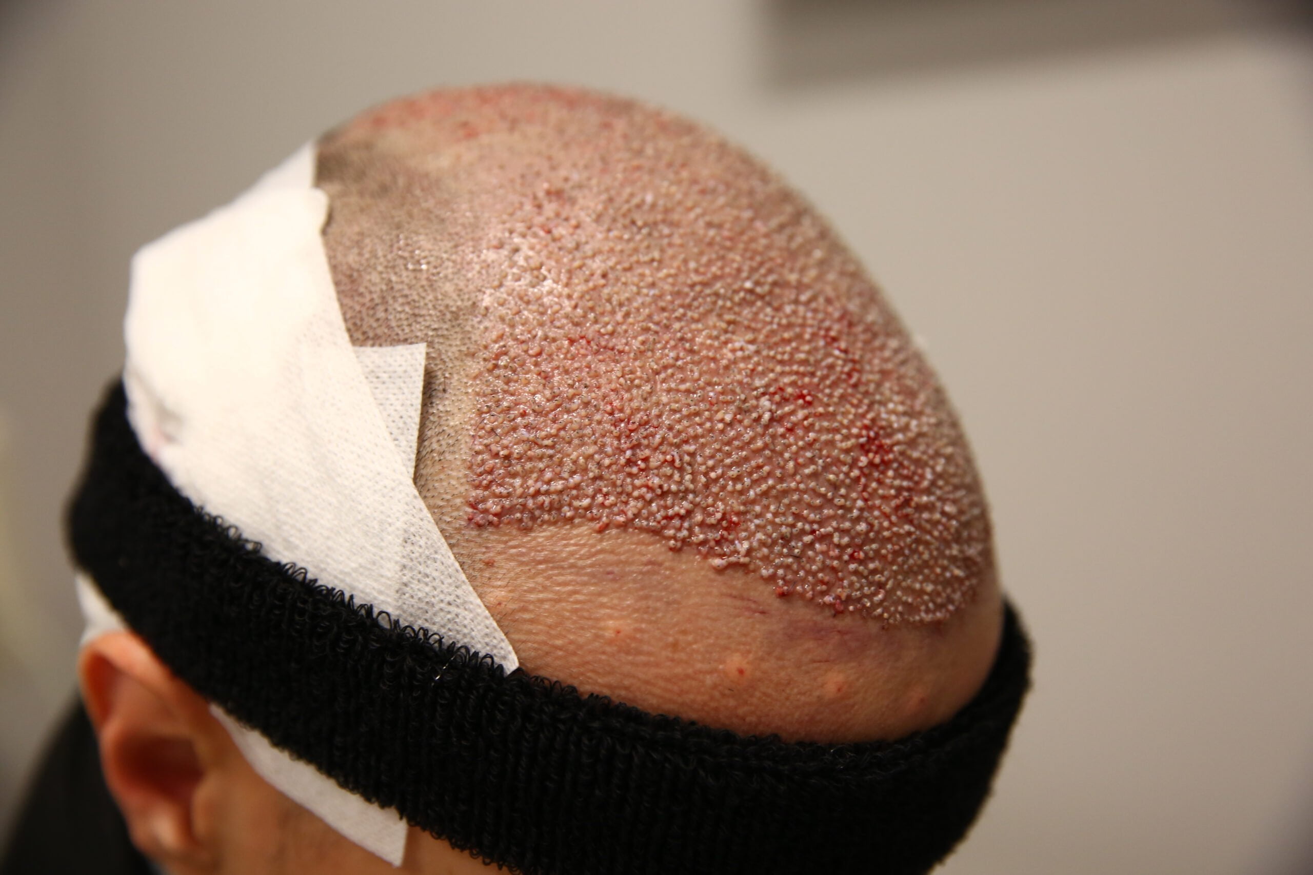 crostas e crostas quando se faz um transplante capilar