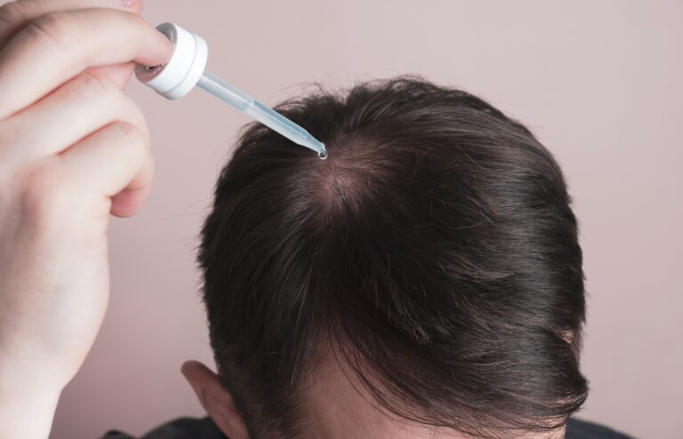 6 Best Topical Finasteride Products For Hair Loss (2024) 7 topical hair treatment