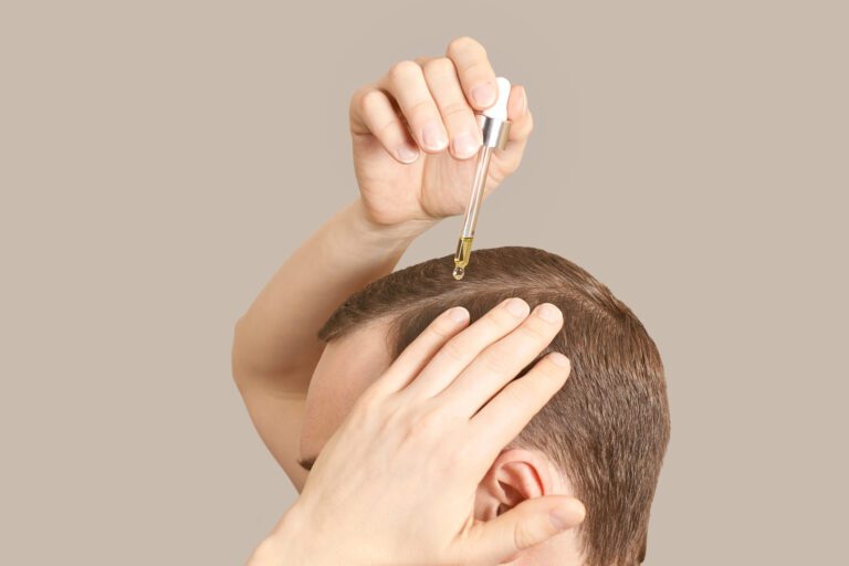 How To Apply Topical Finasteride The Right Way & When 5 Man applying finasteride to hair