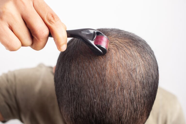 Microneedling for Hair Loss: Does It Work to Regrow Hair? 8 Man using a derma roller on scalp