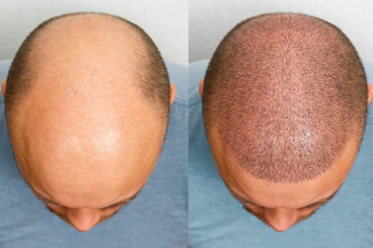 Derma Roller/Microneedling para a queda de cabelo: Resultados antes e depois 6 resultados antes e depois de um homem calvo