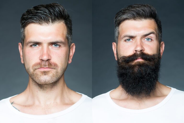 Does Minoxidil Work For Beard Growth? (Before & After Pics) 10 Man with less beard before and more after
