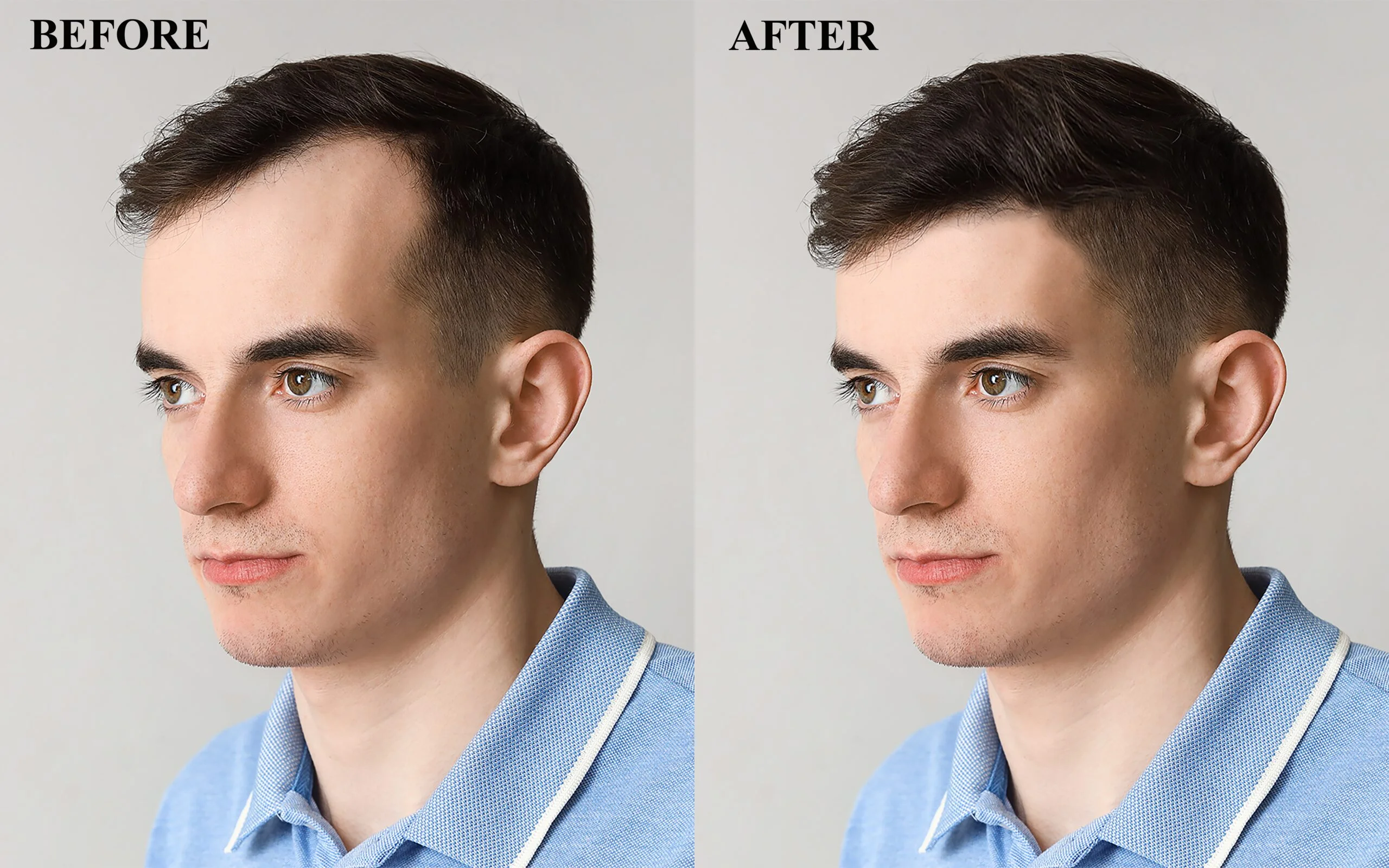 dutasteride before and after results
