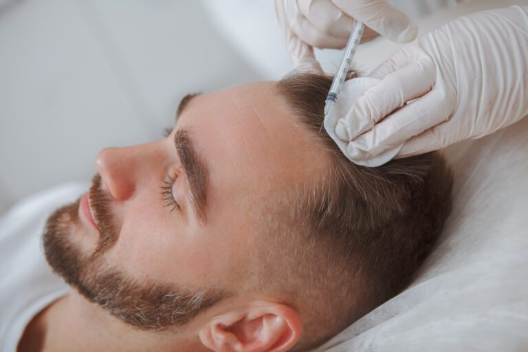 Tudo o que precisa de saber sobre PRP vs PRF para o cabelo 4 Tudo o que precisa de saber sobre PRP vs PRF para o cabelo