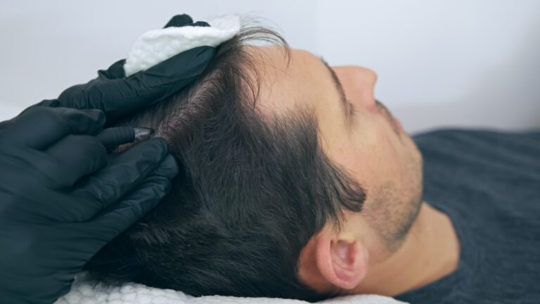 ¿Cuánto costará la micropigmentación del cuero cabelludo en 2024? 2 hombre sometido a micropigmentación capilar
