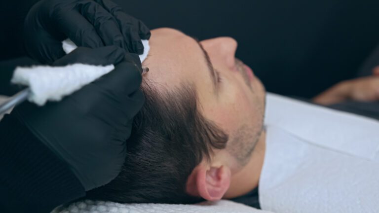 Scalp Micro Pigmentation: A Comprehensive Guide 6 man getting scalp micropigmentation treatment